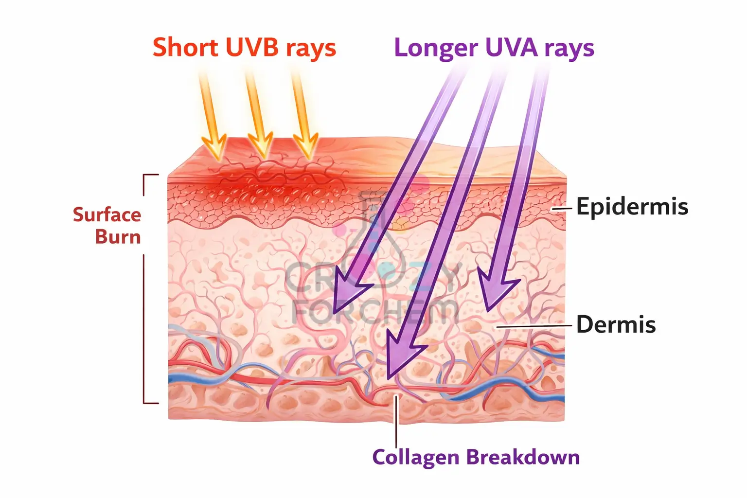 A medical skin cross-section diagram illustrating the different penetration depths of UVA and UVB radiation and their effects on skin cells.
